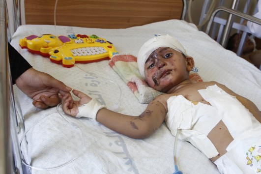 Eighteen-month-old Muhammad Wahdan was badly burned by the blast of an Israeli airstrike that killed his mother and father, and injured his two brothers, Omar and Mus'ab (photo: Samer Badawi)