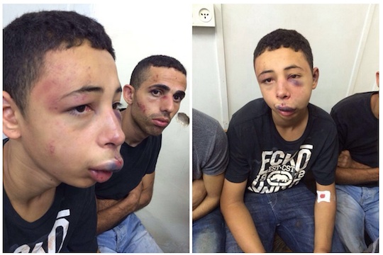 American citizen Tarek Abu Khdeir, 15, after being beaten by Israeli police. (Photos provided to Addameer by the Abu Khdeir family.)