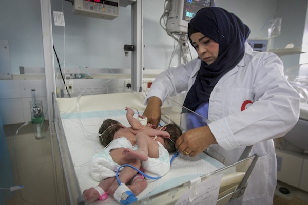 A Palestinian doctor treats conjoined twin boys in a hospital in the West Bank city of Hebron, March 16, 2017. (Wisam Hashlamoun/Flash90)