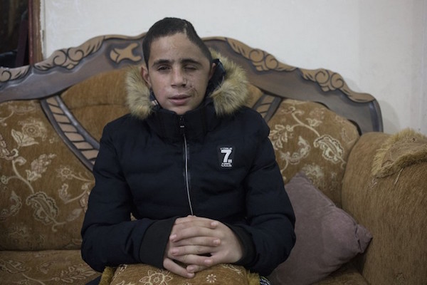 Mohammed Tamimi, 15, was shot in the head with a rubber-coated bullet by the Israeli army shortly before the video of Ahed and Nur was filmed. (Activestills/Oren Ziv)