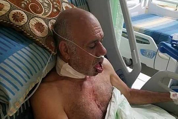 Tayseer Hasan Saliman, 64, is seen in Nablus' Rafidia Hospital, after being brutally attacked by Israeli settlers. Saliman suffered nine fractures in his lower jaw and neck. (Huwarra municipality)