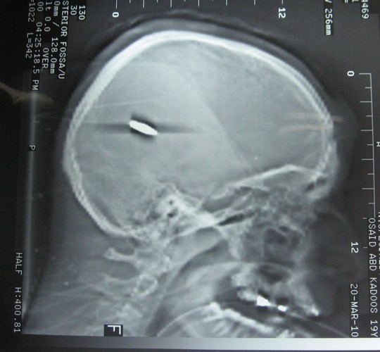 An x-ray showing the bullet lodged inside Usaid Qaddous' skull. 