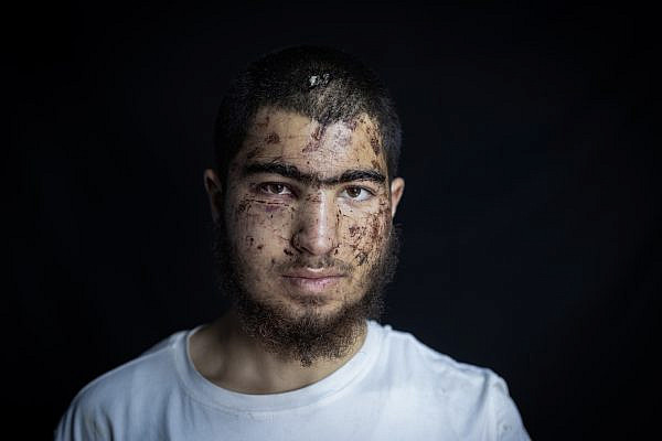 Owais Hammam, 18, was kidnapped and brutally assaulted by Israeli settlers with the assistance of the Israeli military, at the Palestine Medical Complex, in Ramallah, December 6, 2025. (Faiz Abu Rmeleh/Activestills)
