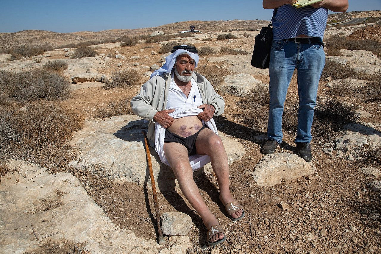 Abu Safi, who was forcibly displaced from the Palestinian community of Ar-Ratheem in the South Hebron Hills as a result of Israeli settler violence, reveals his wounds sustained in a settler attack, occupied West Bank. (Omri Eran Vardi)